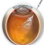 Farmacoterapia Intraocular (Aplicação de drogas no olho)