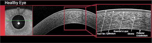 Tomografia de segmento anterior do olho