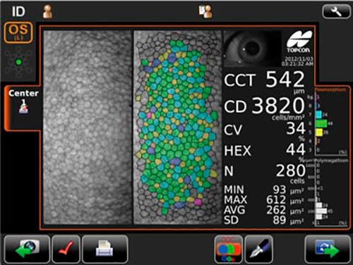 Microscopia especular de córnea